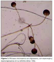 O los elementos fúngicos se presentan en los tejidos como hifas o levaduras con melanina (definición histopatológica). Mucormicosis Cutanea En Un Paciente Inmunocomprometido