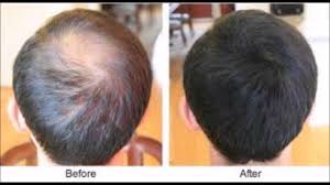 Can hair loss be treated with avodart ? Generic Avodart Canadian Discount Brand Name Avodart Epicureanpiranha Com