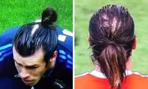 The best suitable hairstyles for big foreheads are the really casual and cool ones. Gareth Bale To Receive A Hair Transplant Daily Mail Online