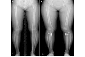 Image result for Genu Varum