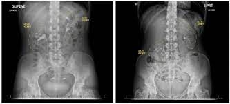 Pain from the kidneys is felt in the sides, or in the middle to upper back (most often under the ribs, to the right or left of the spine). This Woman S Kidney Fell Into Her Pelvis Whenever She Stood Up Here S Why Live Science