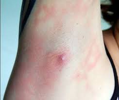 How Do You Get Rid Of Ingrown Hair In Your Underarms Here S A Guide On Causes Remedies And How To Remove I Ingrown Hair Ingrown Hair Cyst Ingrown Hair Armpit