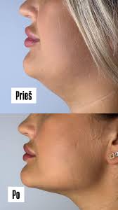 Moterys artėja mūsų diena, tad pasinaudokime proga ir pasidailinkime kūno  formas su 10% nuolaida visom procedūrom ‼️🫶🏼🌷 Beadatinė procedūra💥  Lipolitikais efektyviai mažiname nepageidaujamą riebaliuką!💥 Riebalų  šalinimas lipolitikais