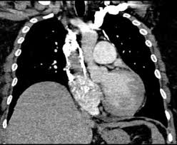 Trombosis venosa profunda & embolia pulmonar. Tromboembolia Pulmonar Asociada Al Sindrome De La Vena Cava Superior De Origen Trombotico Sciencedirect