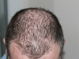 Many people experience changes to their hair at some point during their lives. How To Prevent Hair Loss In Black Men Regrowing Hair Tips