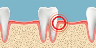 Treatment of gums at home from inflammation is often done with the help of chamomile flowers or calendula.to prepare this balm you need 4 tablespoons of dry ingredients per 1 liter of water. Gum Pain Relief Causes And Treatments Crest