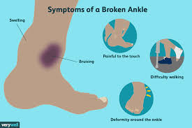 Swelling with an external wound was observed on the lateral malleolus of his right ankle (fig. Most Common Types Of Ankle Fractures