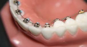 Braket Cesitleri Ortodonti Braket Estetik