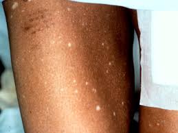 Idiopathische guttata hypomelanosis