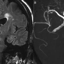 Check spelling or type a new query. A Mri Shows Subacute Infarct Over Right Pons Arrow B Mra Shows Download Scientific Diagram
