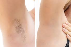 Is laser hair removal really permanent compared to other methods? Laser Hair Removal 101 Benefits Results And Cost