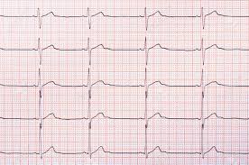 Heart Rhythm Chart For Background Usage