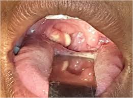 Image result for Peritonsillar Abscess