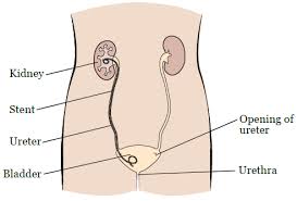 Ureteral Stent Placement Memorial Sloan Kettering Cancer Center