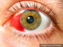 Image result for Acute Red Eye