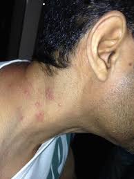 This hotel is 1.3 mi (2 km) from angel stadium of anaheim and 2.4 mi (3.9 km) from anaheim convention center. Bad Case Of Bed Bug Bites At Aloft Hotel Abu Dhabi Starwood Hotels Flyertalk Forums