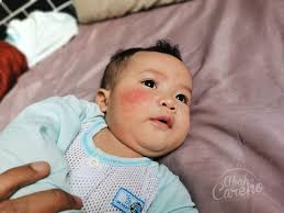 Kurap (dermatophytosis) terdiri dari beberapa jenis penyakit kulit yang disebabkan oleh ‎jangkitan kulat. Penting Untuk Tahu Ubat Sapu Jenis Apa Yang Sesuai Untuk Masalah Kulit Baby Blog Abah Careno