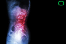 Osteochondrose Und Spondylarthrose Der Verschleiss Der Wirbelsaule Und Bandscheibenverschleiss Schmerztherapie Ohne Medikamente Bomedus