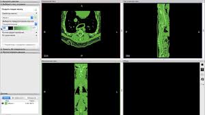 Jump to navigation jump to search. Dicom To Stl Translation Of Mri Or Ct Into A 3d Model Studia3d Com