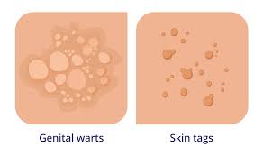 Image result for genital warts