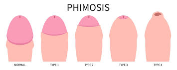 Image result for paraphimosis