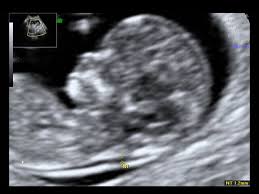 What is us obstetric nuchal dating scan. Nuchal Translucency Scans Nt Scans Ultrasound Plus