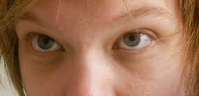 The thin eyelid veins can easily bulge and become enlarged due to venous deficiency. Periorbital Dark Circles Wikipedia