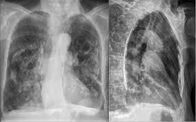 Pleural plaques are benign areas of thickened tissue that form in the pleura, or lung lining, 10 to 30 years after asbestos exposure. Calcified Pleural Plaques Pacs Entwicklung