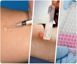 Screening Tests For Tuberculosis
