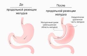 Kak Zhivyot Chelovek Bez Zheludka Mama Doktor Yandeks Dzen