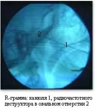 как лечить воспаление тройничного лицевого нерва в домашних условиях Nevralgiya Trojnichnogo Nerva
