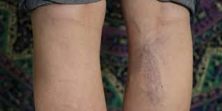 Varices Durante El Embarazo Completa Info