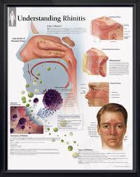 Understanding Rhinitis Chart 22x28 Medical Technology Medical Posters Medical Science
