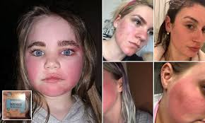 Coconut face mask left 10-year-old's skin red raw for FOUR days