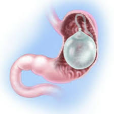 بالون المعدة السنوي Gastric Ballon Twitter