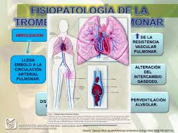 La embolia pulmonar es un cuadro grave que por lo general ocurre cuando un trombolocalizado en una de las venas índice. Tromboembolismo Pulmonar Sintomas Pdf Embolia Pulmonar