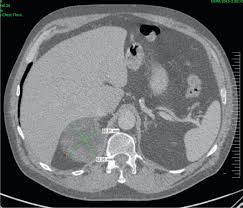 Dedicated adrenal ct is preferred to. Racgp Incidental Adrenal Masses A Primary Care Approach
