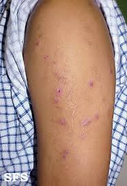 Image result for Neurotic Excoriation