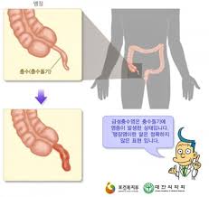 충수 이 님의 아이디어 더 보기. ê¸‰ì„±ì¶©ìˆ˜ì—¼ ìˆ˜ìˆ ë³´ë‹¤ ì•½ë¬¼ ì¹˜ë£Œê°€ ë‚«ë‹¤ Sciencetimes