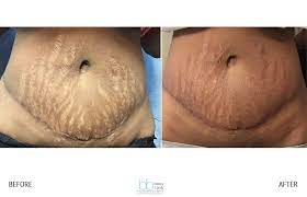 This treatment utilizes laser wavelengths to remove thin layers of skin around stretch marks. Skinfinity In Hillcrest San Diego Eclipse Skinfinity Rf