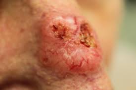 Steven wang explains what causes this type of cancer and when to seek professional help. Carcinoma Basal Cell And Squamous Cell Carcinoma