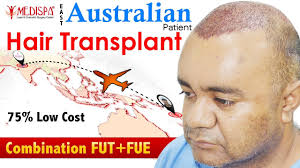 Telogen effluvium occurs when your body is stressed in some way—perhaps by childbirth, illness, surgery, mental stress, poor nutrition, or medication—which causes hair follicles to enter into the resting stage (telogen phase) prematurely. Australian Patient Hair Transplant Experience With Dr Suneet Soni Medispa India Baldtruthtalk Com