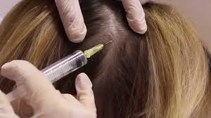 They explain your hair loss options and let you make the decisions that are right for you. Toronto Hair Loss Treatment With Prp Promo 599 Session