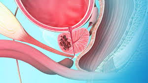 We recommend that men—with or without prostate cancer—consume a healthy diet rich in a variety of vegetables, including cooked tomatoes. 5md6bwwqkzcjdm
