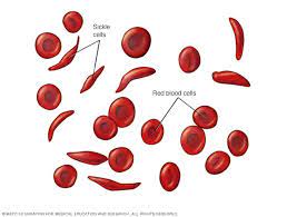 Sickle cell disease (scd), or sickle cell anaemia, is a major genetic disease that affects most countries in the african region. Sickle Cell Anemia Symptoms And Causes Mayo Clinic