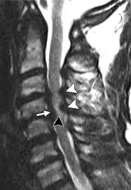 Scott olson / staff / getty images Incomplete Cord Syndromes Clinical And Imaging Review Radiographics