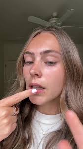 Dealing with Lip Pimples: Tips and Tricks