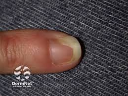 Image result for Akutní zánět nehtového lůžka