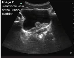 Second Chance On Bladder Ultrasound Emergency Physicians Monthly