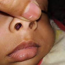 Nasal polyps are yellowish, grey, pedunculated sacs which usually cause progressive nasal obstruction. Asktheexperts My 4 Year Old Boy Has Nasal Polyps In His Nose What Should I Do Firstcry Parenting